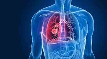 Месячник осведомленности о раке легких